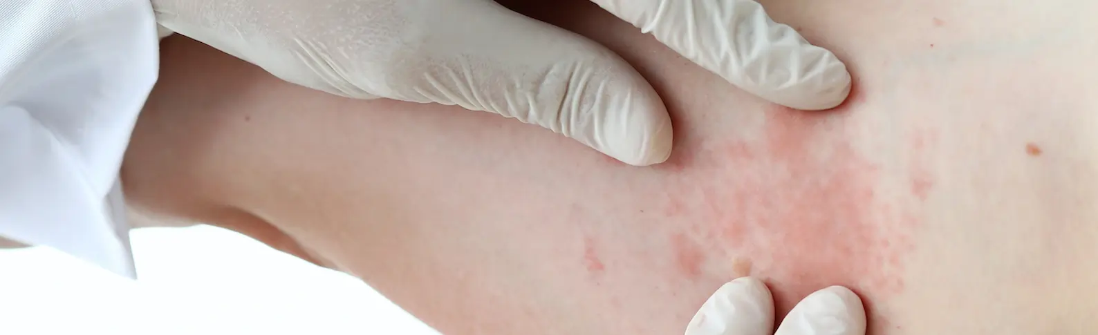 Ein Arzt schaut sich einen Arm an, dort hat sich scheinbar Hautpilz gebildet